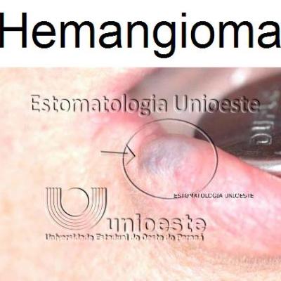 01 Hemangioma Capilar