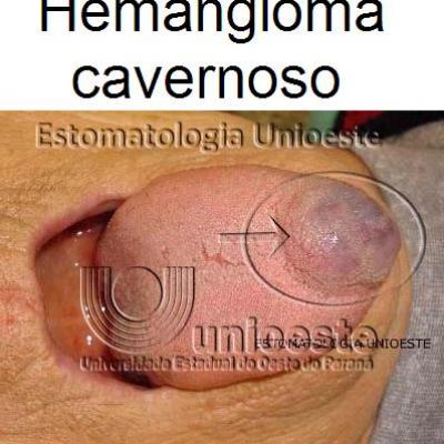 02 Hemangioma Cavernoso