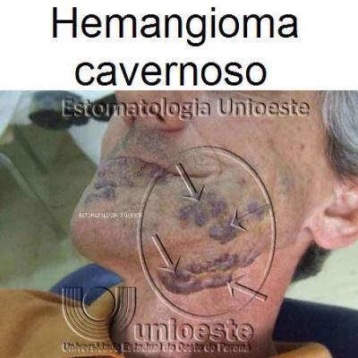 03 Hemangioma Cavernoso