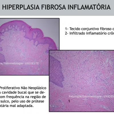 Hiperplasia Fibrosa Inflamatia Cia